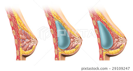 Woman breast implant cross section. 29109247