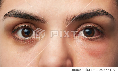 allergy reaction on eye 29277419