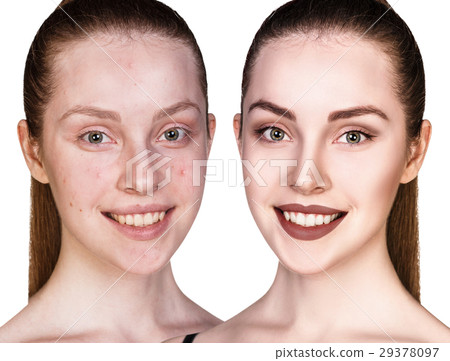 Girl with acne before and after treatment Girl with acne before and after treatment 29378097