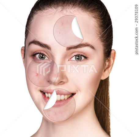 Circles with acne unstick from healthy skin. Circles with acne unstick from healthy skin. 29378109