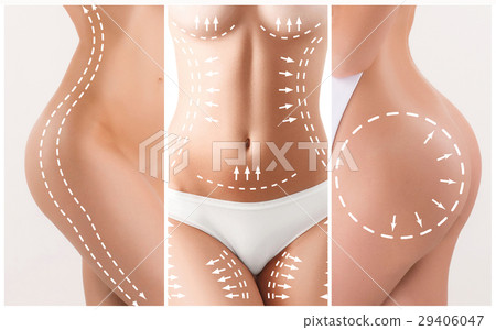 The cellulite removal plan. White markings on The cellulite removal plan. White markings on 29406047