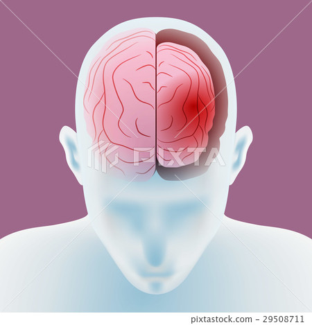 Brain atrophy image 29508711