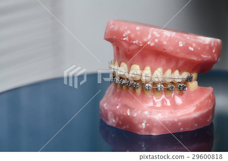Human jaw or teeth model with wired dental braces 29600818