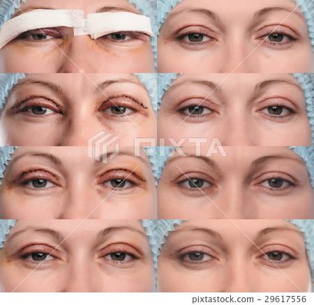 Blepharoplasty of the upper eyelid. 29617556