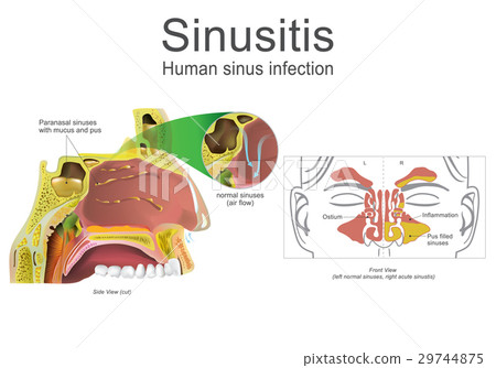 Human Sinusitis, Inflammation. Human Sinusitis, Inflammation. 29744875