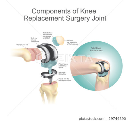 Components of knee replacement surgery joint. 29744890