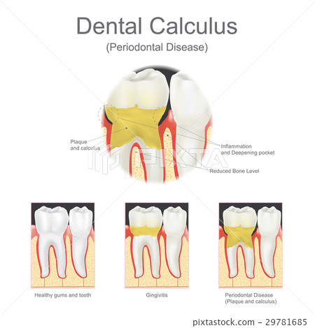 Dental calculus periodontal disease. Dental calculus periodontal disease. 29781685