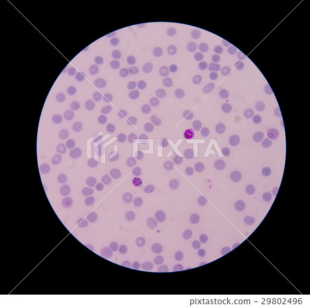 Malaria ring form infection on red blood cells. 29802496