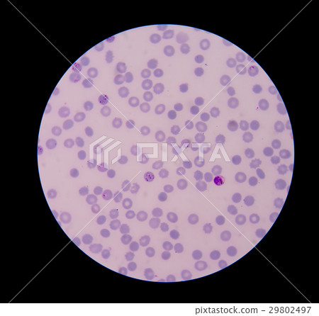 Malaria ring form infection on red blood cells. Malaria ring form infection on red blood cells. 29802497