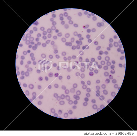 Malaria ring form infection on red blood cells. Malaria ring form infection on red blood cells. 29802499