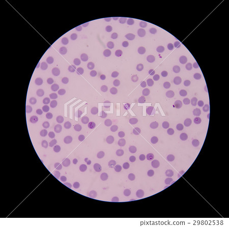 Malaria ring form infection on red blood cells. Malaria ring form infection on red blood cells. 29802538