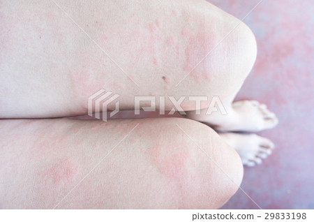 Rash from allergic infection, eczema dermatitis Rash from allergic infection, eczema dermatitis 29833198