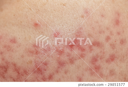 closeup skin problems, nodular cystic acne skin 29851577