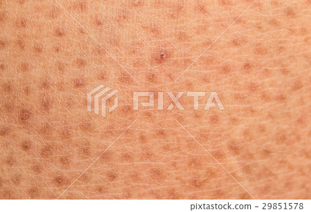 skin problem,Dry skin ichthyosis vulgaris 29851578