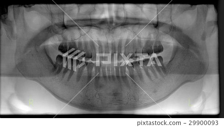 牙科X光片（正常圖像·陰性/陽性反轉） 29900093