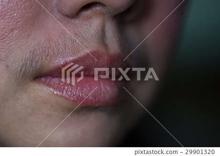 Infection on mouth 29901320