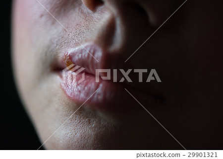 Infection on mouth Infection on mouth 29901321