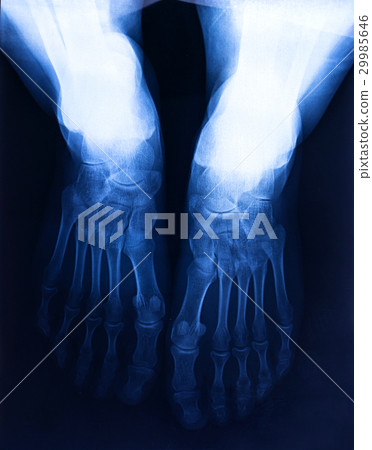X-ray human's ankle with arthritis , top view. 29985646