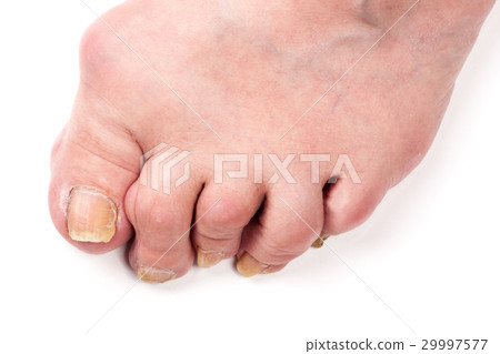 Rheumatoid polyarthritis on foot isolated on white 29997577
