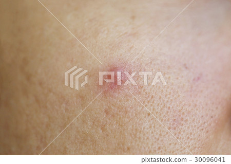Acne on face of the women. Acne on face of the women. 30096041