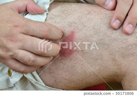 Scratching Skin After a Bite Scratching Skin After a Bite 30173806