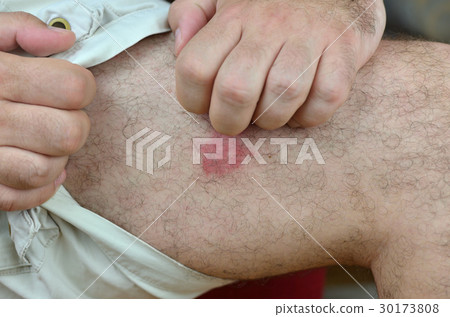 Scratching the Place of Insect Bites Scratching the Place of Insect Bites 30173808