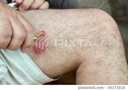 Smearing Gel on Skin Smearing Gel on Skin 30173810