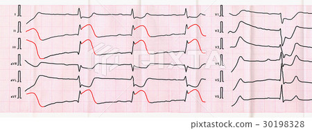 ECG tape with macrofocal myocardial infarction ECG tape with macrofocal myocardial infarction 30198328