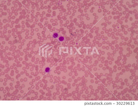 Blood smear show Red blood cells with  30229613