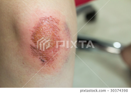 Fresh wound with lymph and blood on female knee 30374398
