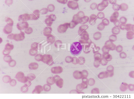 Blast cells in blood smear. 30422111