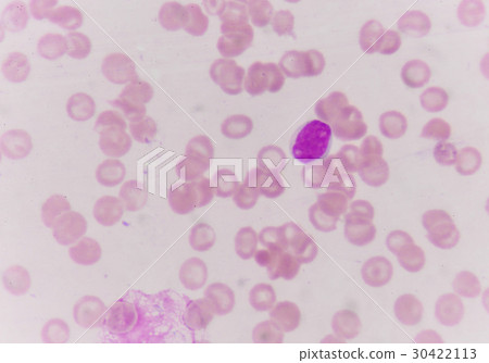 Blast cells in blood smear. 30422113