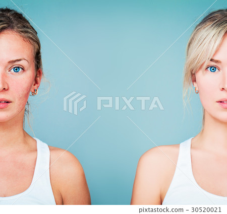 Young Woman with Perfect Skin and Skin Problem 30520021