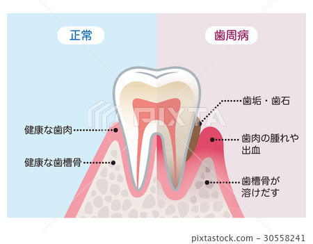 健康牙齒和牙周病牙齒的比較 健康牙齒和牙周病牙齒的比較 30558241