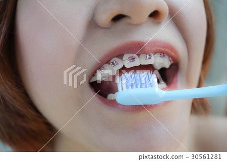 Closeup mouth with teeth braces and toothbrush 30561281