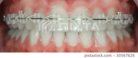 teeth with ceramic braces 30567626