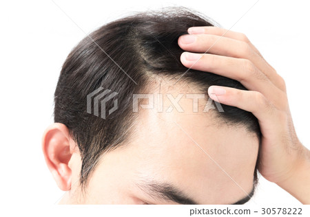 Young man serious hair loss problem for health 30578222