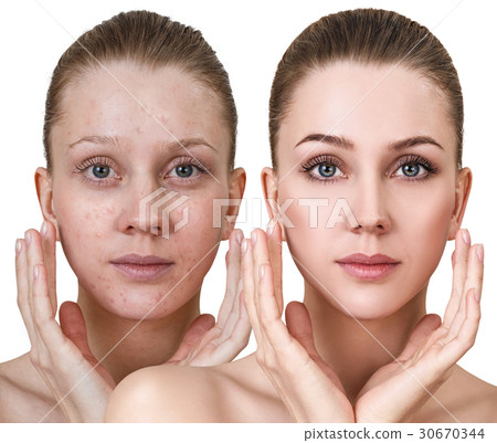 Woman before and after treatment and makeup. Woman before and after treatment and makeup. 30670344