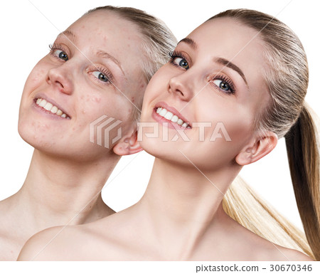 Woman before and after treatment and makeup. Woman before and after treatment and makeup. 30670346