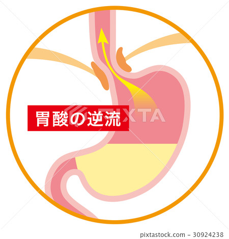 胃酸反流性食管炎 30924238