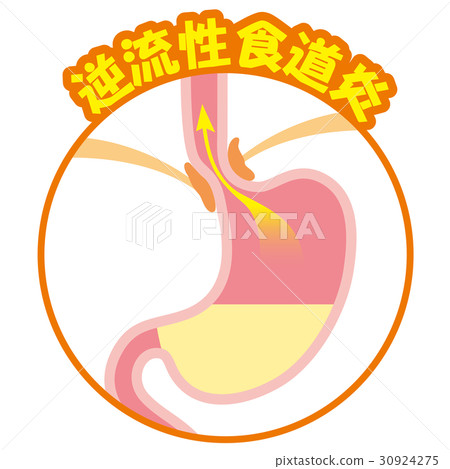 胃酸反流性食管炎 胃酸反流性食管炎 30924275