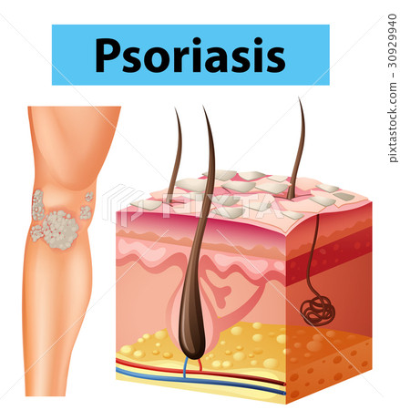 Diagram showing psoriasis on human skin Diagram showing psoriasis on human skin 30929940