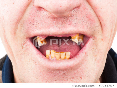 Bad teeth, smoker Bad teeth, smoker 30935207