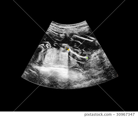 Ultrasound of baby in mother's womb. 30967347