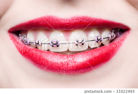 Teeth with braces Teeth with braces 31022993