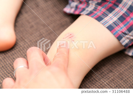 嬰兒膝蓋受傷 嬰兒膝蓋受傷 31106488