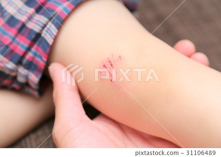 Injury in an infant's knee 31106489