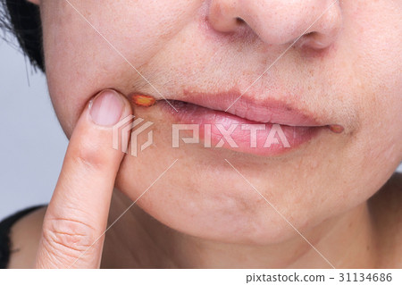 Angular cheilitis , inflammation of the lips 31134686