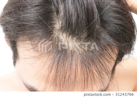Young man serious hair loss problem Young man serious hair loss problem 31243766