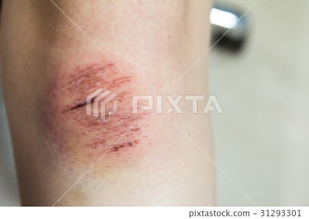 Fresh wound with lymph and blood on female knee 31293301